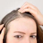 Woman lifting hair to reveal thinning scalp at the crown area