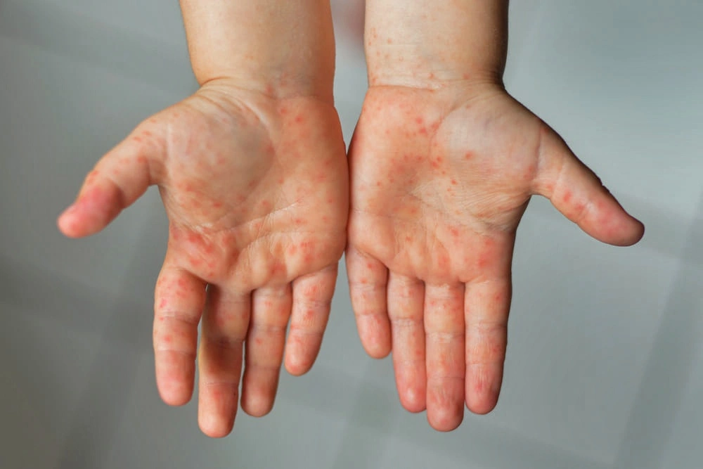 Masih Ditemukan, Campak di Indonesia Jadi Sorotan